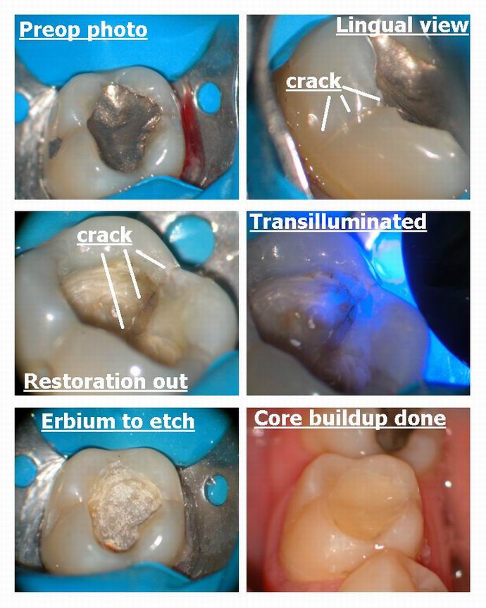 Resize of Crack on occlusal.jpg